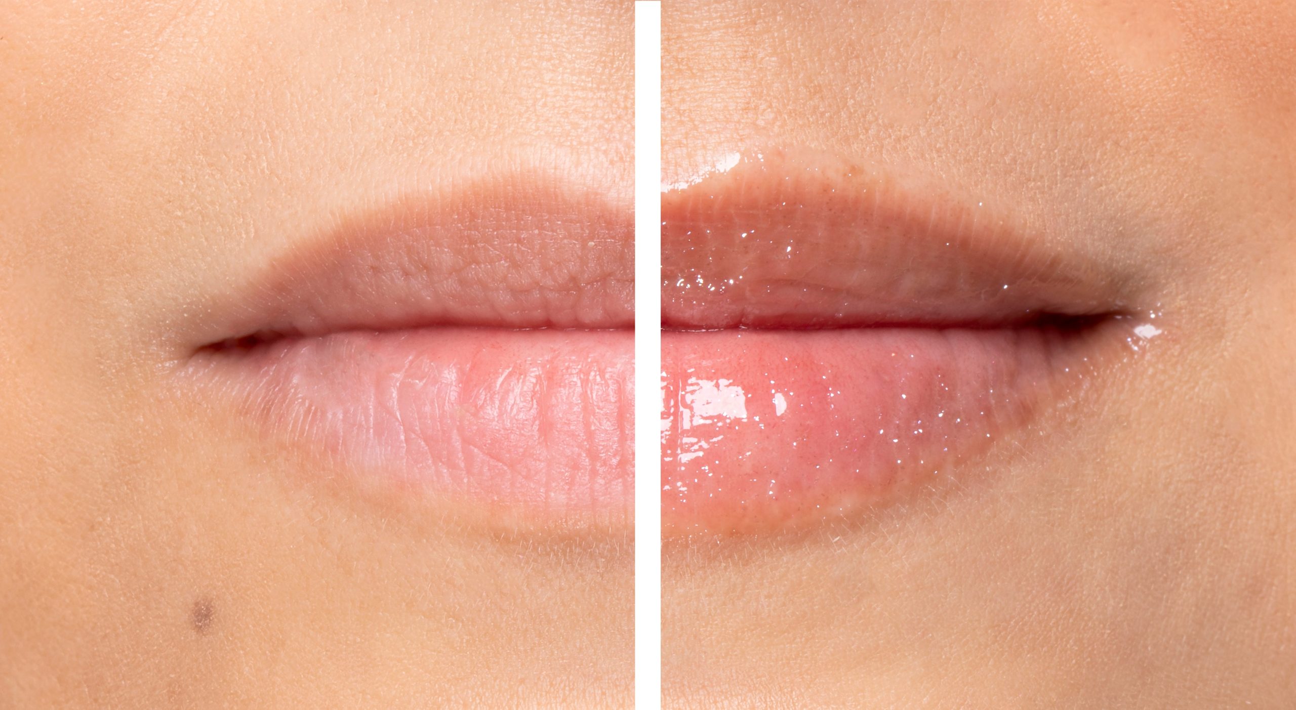 1711772_DiamondLipPlumper_Model_BA.jpg